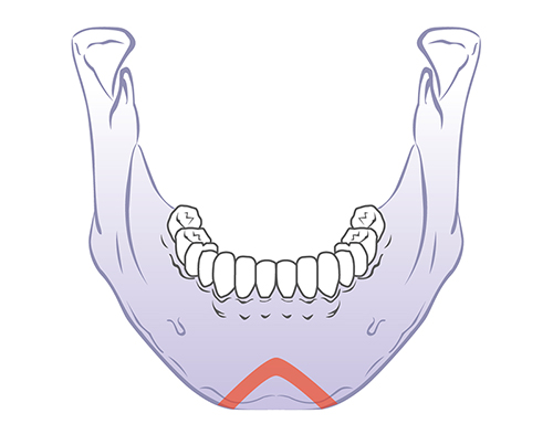 V-Line Square Jaw Surgery - The Appropriate Surgical Method According to the Shape of the Chin image 7