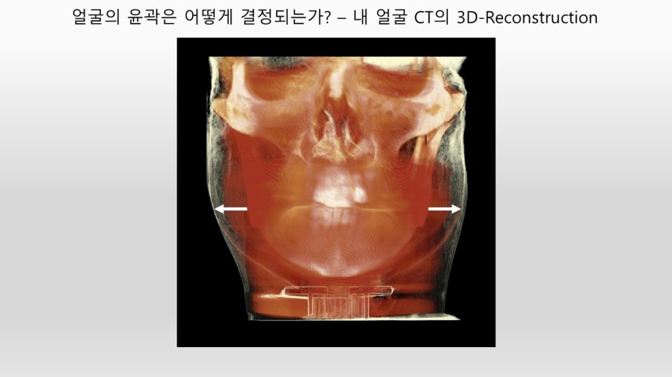 안면윤곽 개선에 관한 단계별 제안 관련 이미지 3