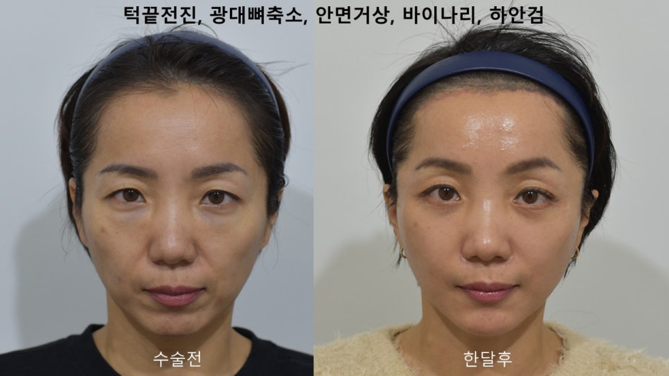 "윤곽거상 수술 " 실제 사례 소개 관련 이미지 9