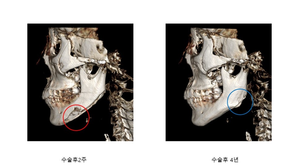 사각턱 수술후 시기에 따른 아랫턱뼈의 형태변화 관련 이미지 27
