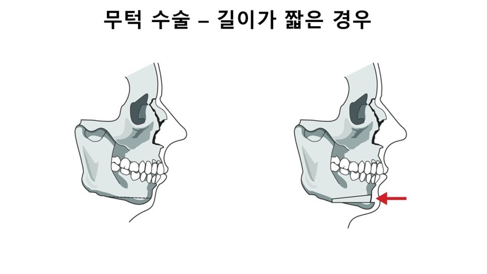 입체적인 옆라인의 완성, 무턱과 이중턱을 동시에 해결하는 방법 관련 이미지 21