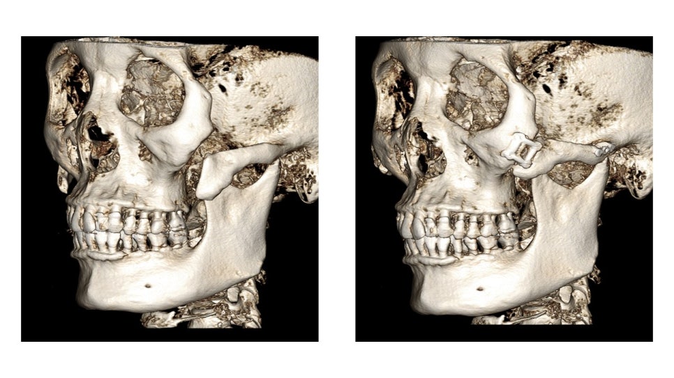 Why Cheekbone Revision Surgery for Sagging Cheeks and Nonunion 30 Years After Cheekbone Surgery Succeeded After a Facelift image 5