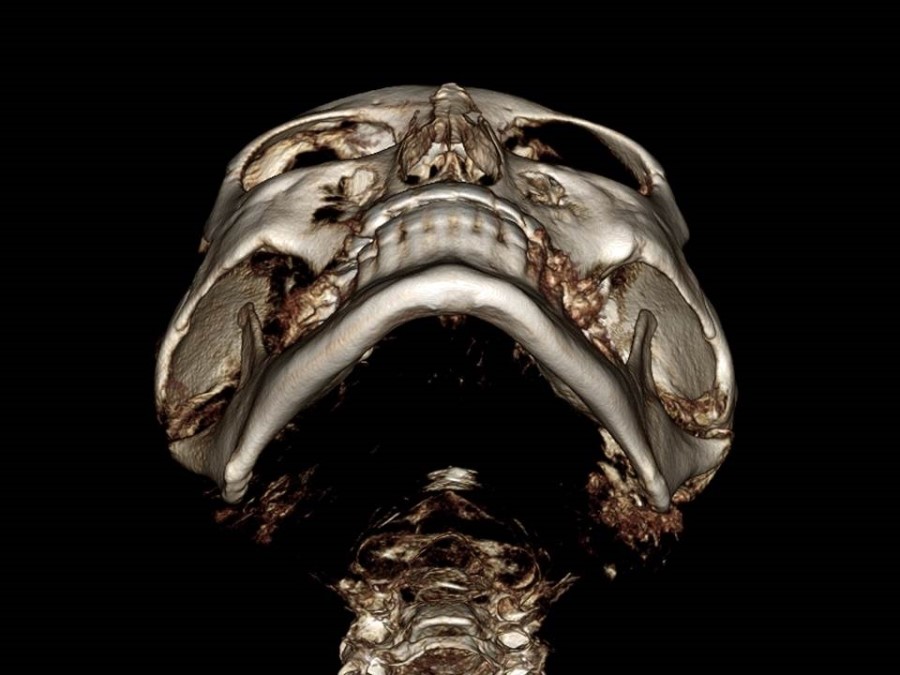 Understanding the Structure of the Cheekbone and Cheekbone Reduction Surgery image 4
