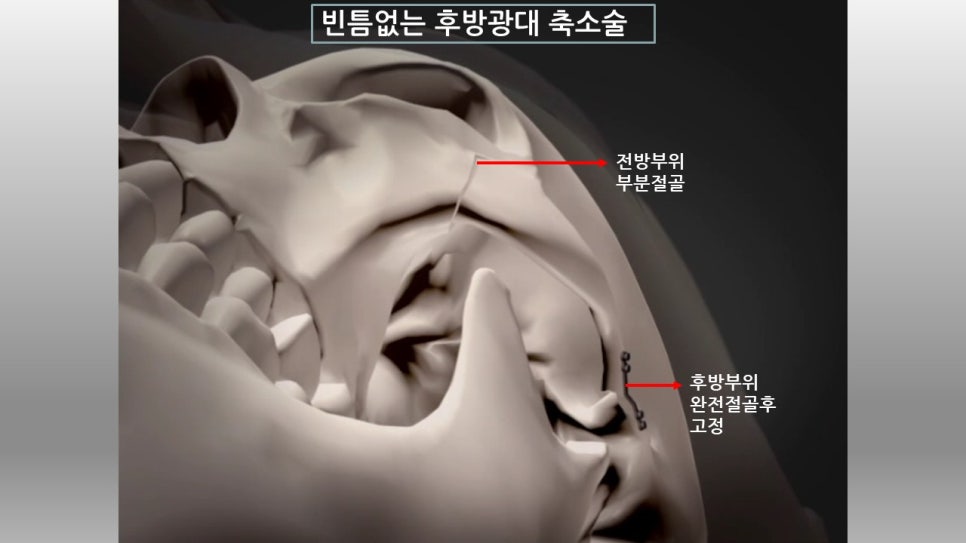 광대뼈축소성형술 - 고정 방식에 관한 설명 관련 이미지 8