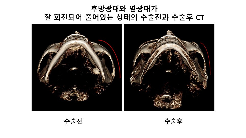 후방광대, 뒷광대 축소에 관한 그릇된 정보와 정확한 이해 관련 이미지 8