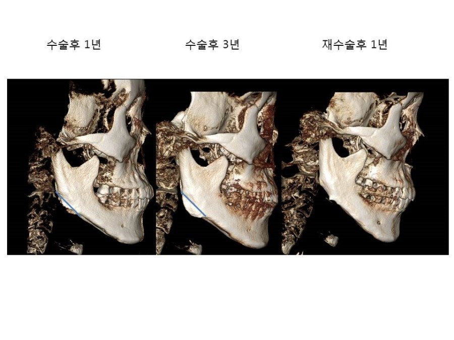 사각턱 수술후, 각진부위의 뼈가 시간이 지나서 일부 생기는 경우 관련 이미지 2