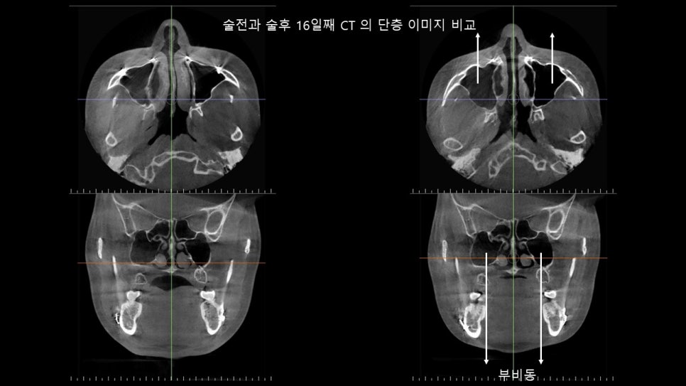 광대뼈축소성형술 증례 리뷰 -1 관련 이미지 20