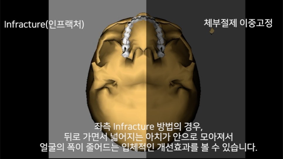 Why Do So Many People Consider Revision Surgery After Zygomatic Reduction Surgery? image 2