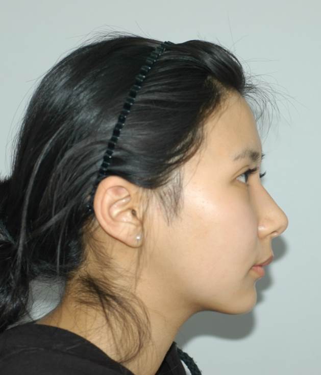 Double Chin Liposuction image 5