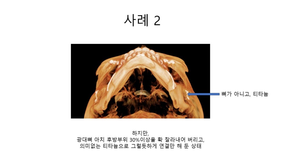 A Zygomatic Surgery Outcome That Makes Anger Surge image 12