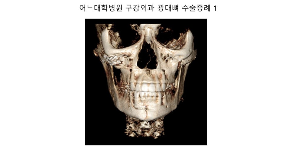 안면윤곽 수술전과 후의 증례 고찰 관련 이미지 13