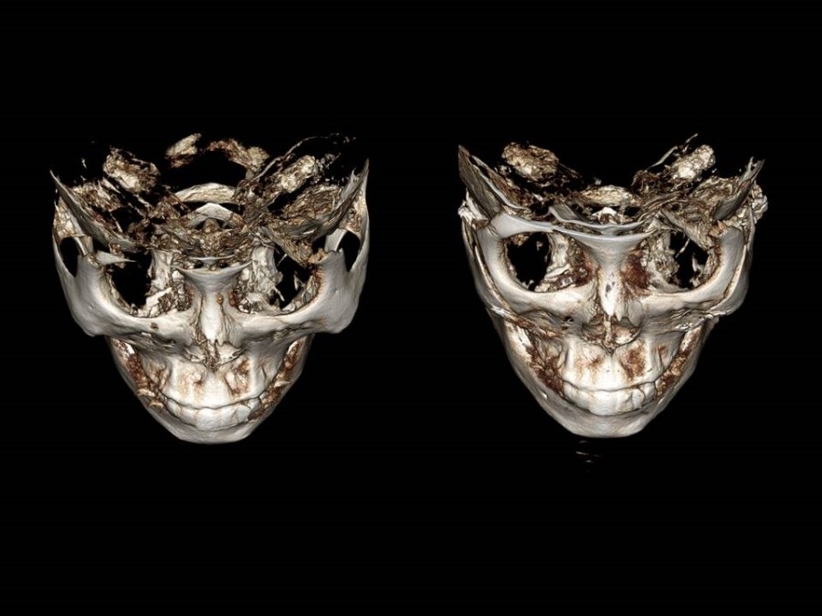 Zygoma Reduction Surgery Through Complete Osteotomy of the Body and Arch image 17