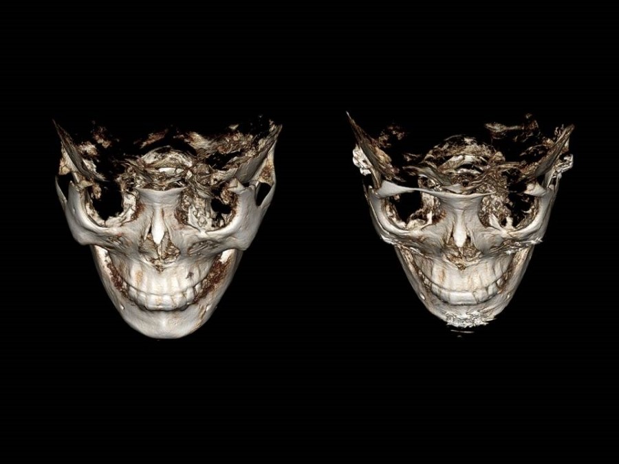 Zygoma Reduction Surgery Through Complete Osteotomy of the Body and Arch image 25
