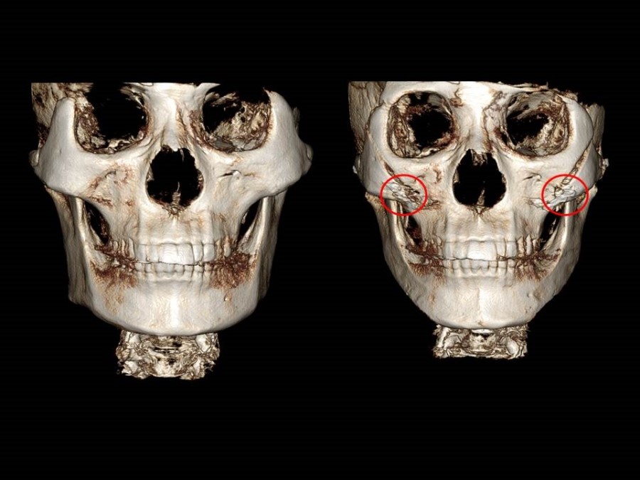 Zygoma Reduction Surgery Through Complete Osteotomy of the Body and Arch image 2