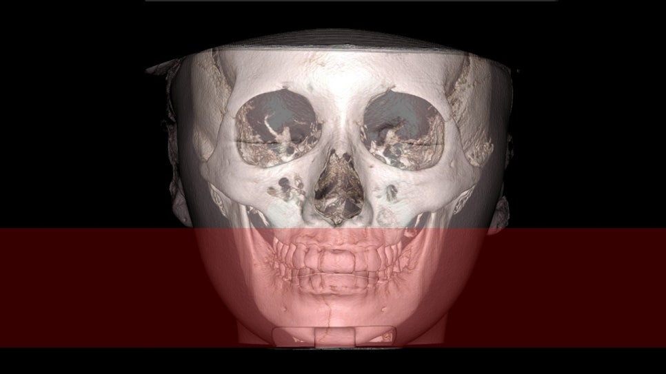 How Is Face Shape Determined? Factors That Determine Face Shape and Facial Contouring Surgery image 13