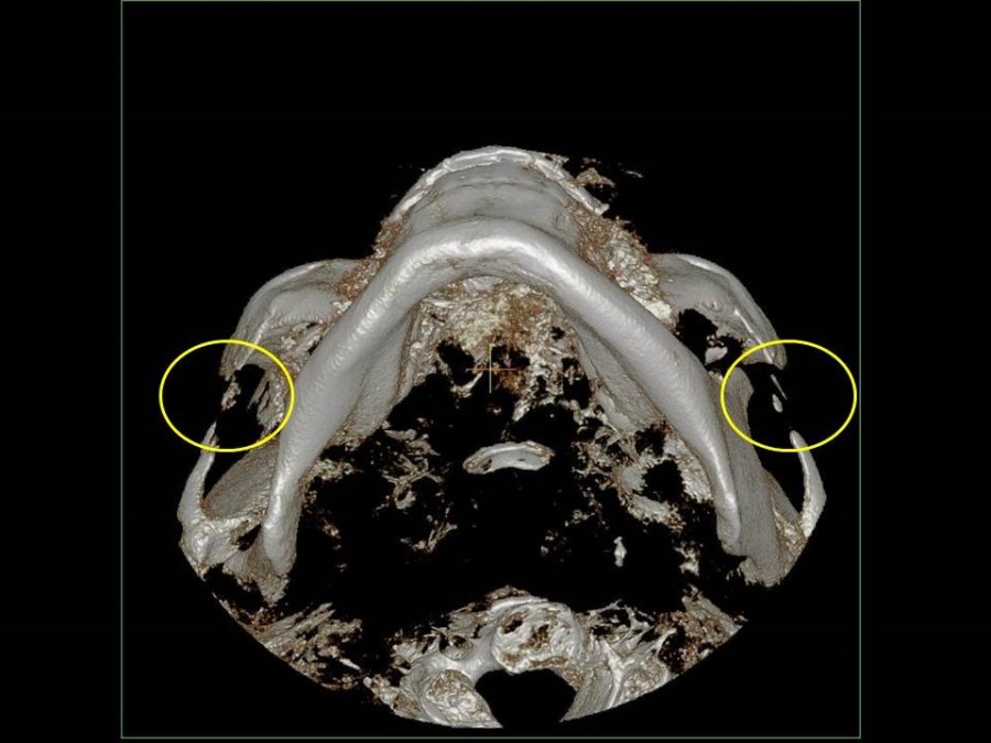 Complication Cases of Zygomatic Reduction Surgery image 4