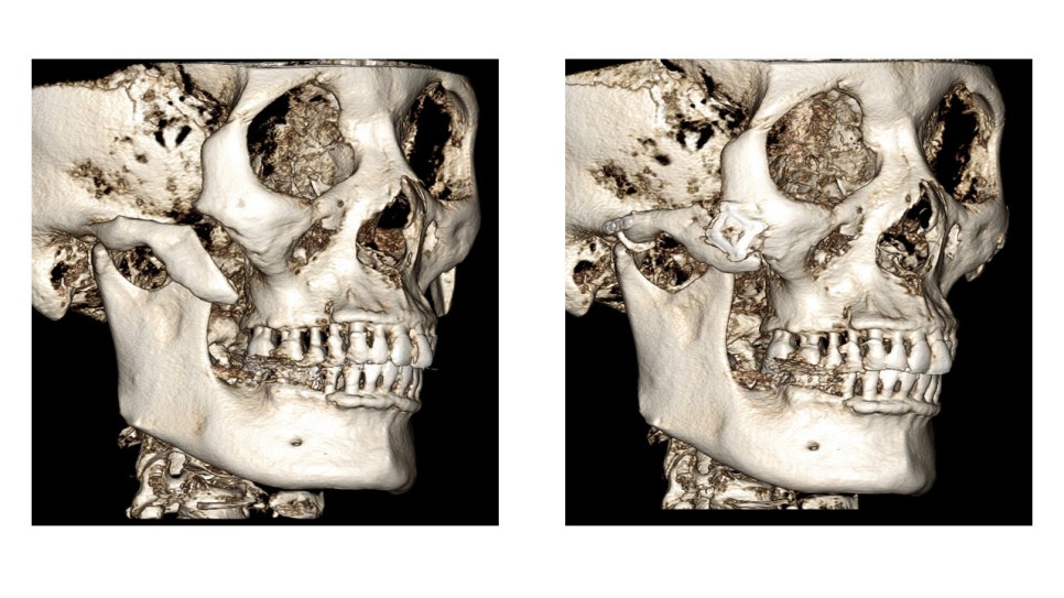 Why Cheekbone Revision Surgery for Sagging Cheeks and Nonunion 30 Years After Cheekbone Surgery Succeeded After a Facelift image 4