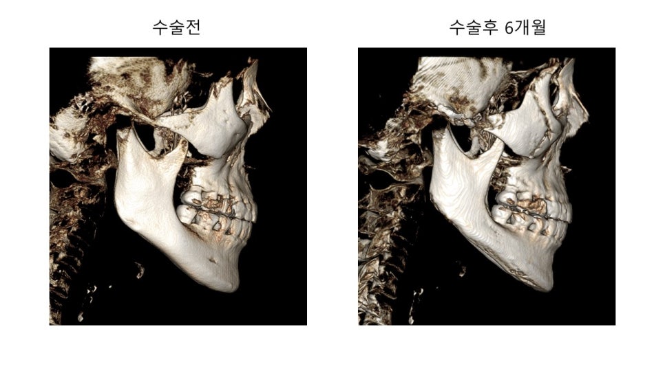 안면윤곽 수술전과 후의 증례 고찰 관련 이미지 8