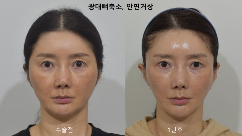 "윤곽거상 수술 " 실제 사례 소개 관련 이미지 1