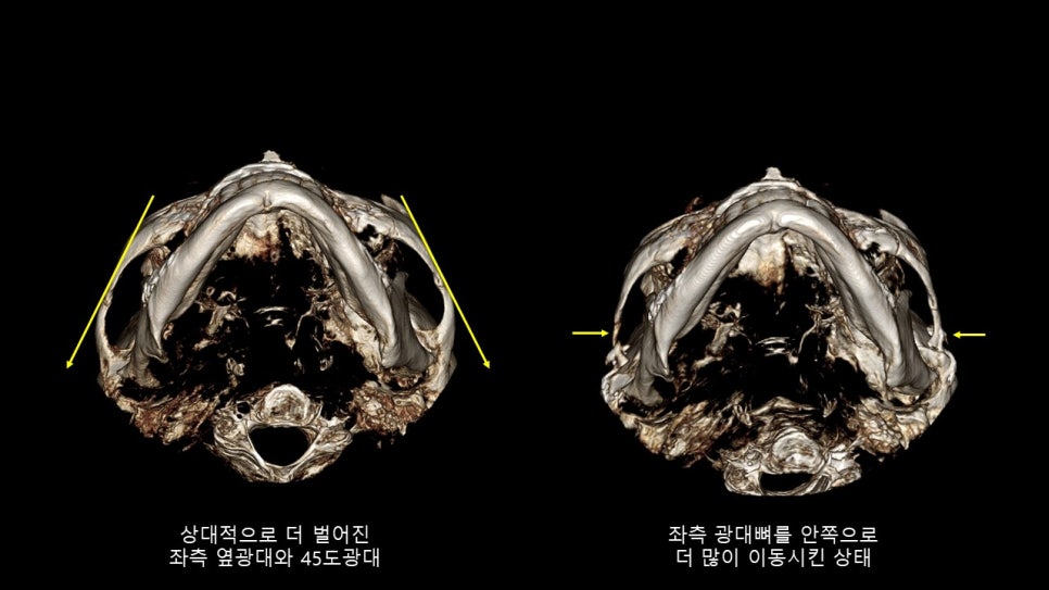 광대뼈축소성형술 증례 리뷰 -1 관련 이미지 12