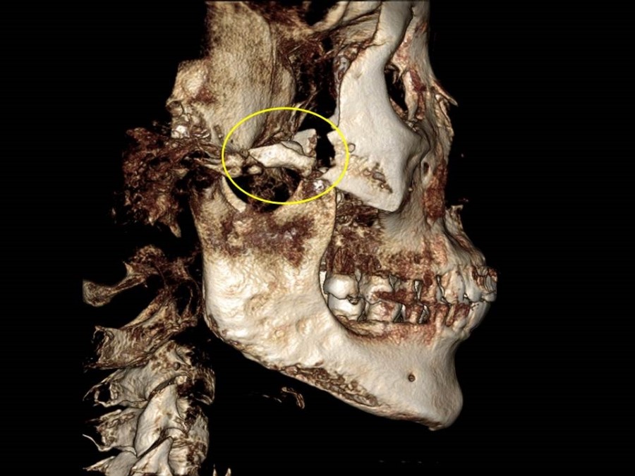 Complication Cases of Zygomatic Reduction Surgery image 6