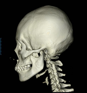 안면골의 삼차원 단층촬영(3D-CT, 3DCT) 란? 관련 이미지 2
