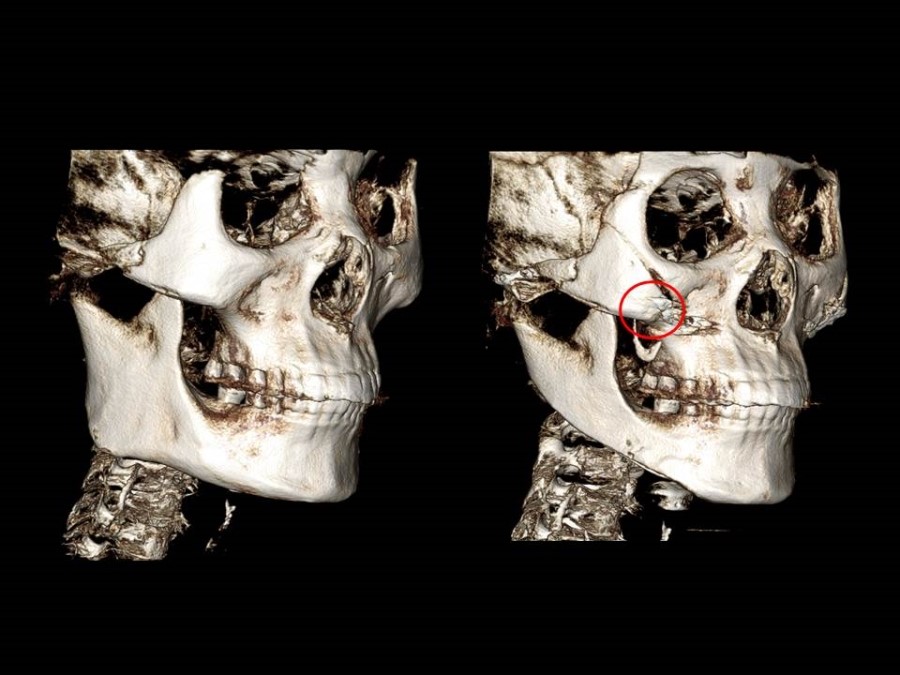Zygoma Reduction Surgery Through Complete Osteotomy of the Body and Arch image 4