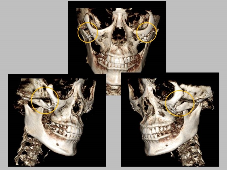 Meticulous Zygomatic Reduction Surgery image 5