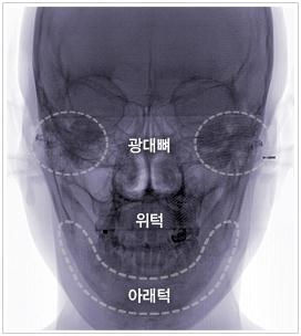 넓은 얼굴폭 줄이기-1( 옆광대축소) 관련 이미지 1