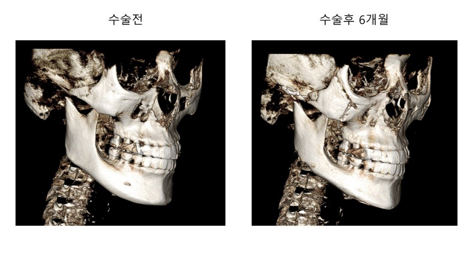 안면윤곽 수술전과 후의 증례 고찰 관련 이미지 6