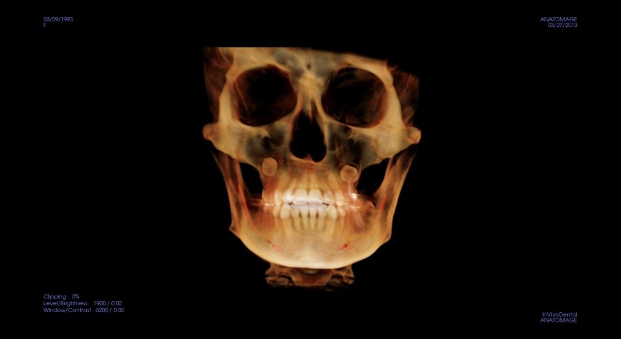 V-Line Square Jaw Surgery - The Truth and Reality of T-Osteotomy image 2