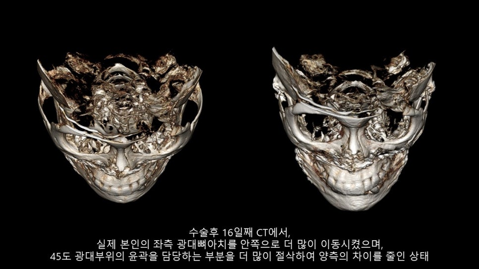 광대뼈축소성형술 증례 리뷰 -1 관련 이미지 17