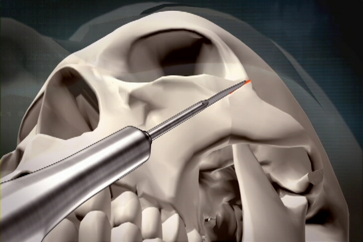 The Evolution of Infracture Technique for Reduction Malarplasty 관련 이미지 2