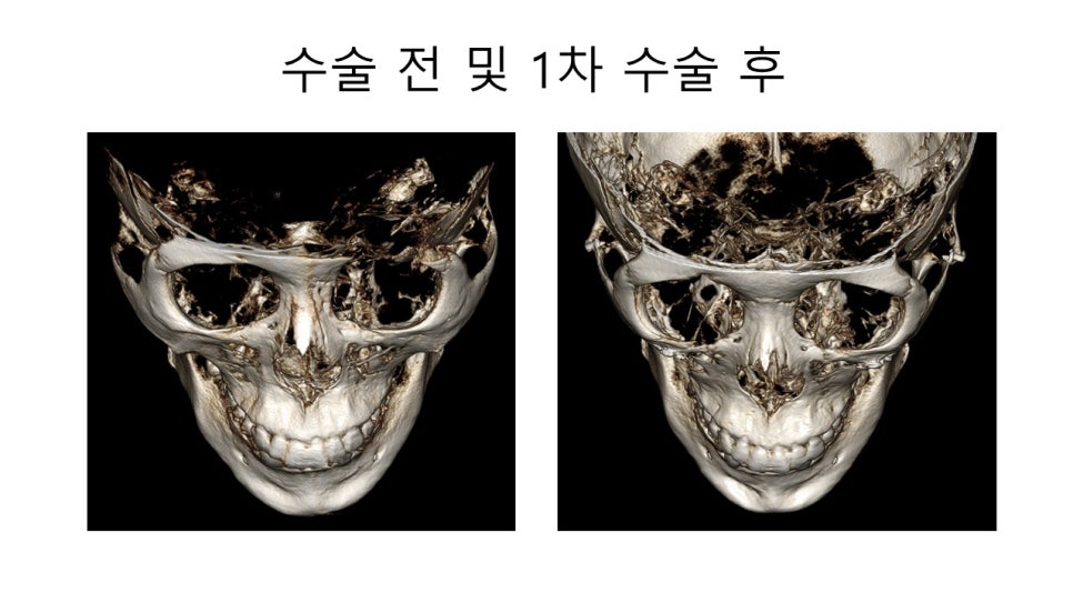 광대뼈 축소성형술 - 수술방법에 따른 모습변화의 차이 관련 이미지 5