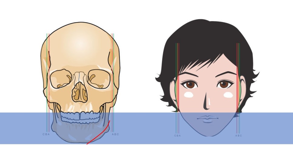 How Is Face Shape Determined? Factors That Determine Face Shape and Facial Contouring Surgery image 17