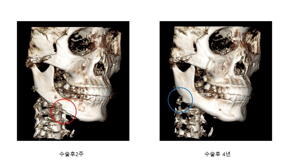 사각턱 수술후 시기에 따른 아랫턱뼈의 형태변화 관련 이미지 25