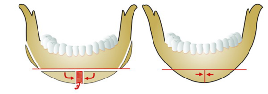 V-Line Facial Contouring Surgery - 1. When the Chin Length Is Appropriate image 2