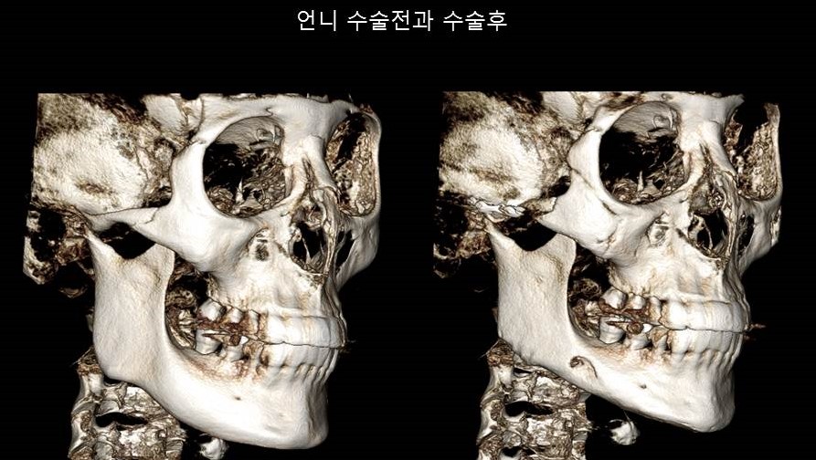 Understanding Square Jaw Surgery - Comparison of Postoperative Results Between Biological Sisters Who Underwent Surgery Using Different Methods image 2