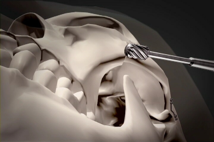 Understanding the Structure of the Cheekbone and Cheekbone Reduction Surgery image 22