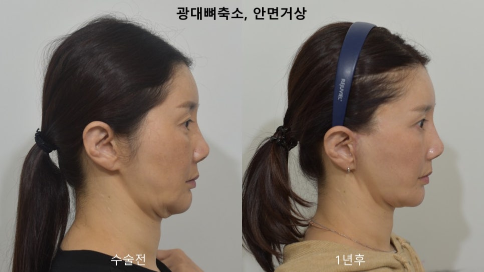 "윤곽거상 수술 " 실제 사례 소개 관련 이미지 4