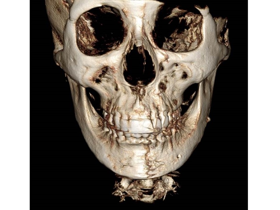 V-Line Square Jaw Surgery - The Truth and Reality of T-Osteotomy image 8