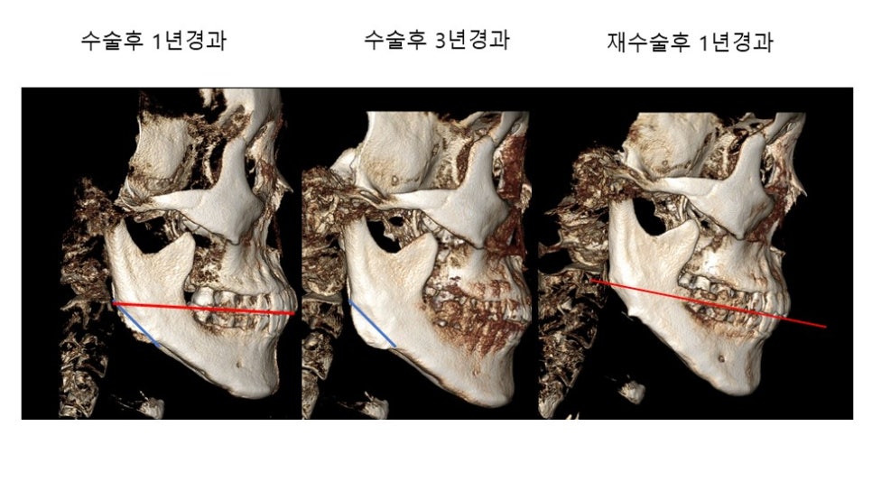 사각턱 수술후 시기에 따른 아랫턱뼈의 형태변화 관련 이미지 3