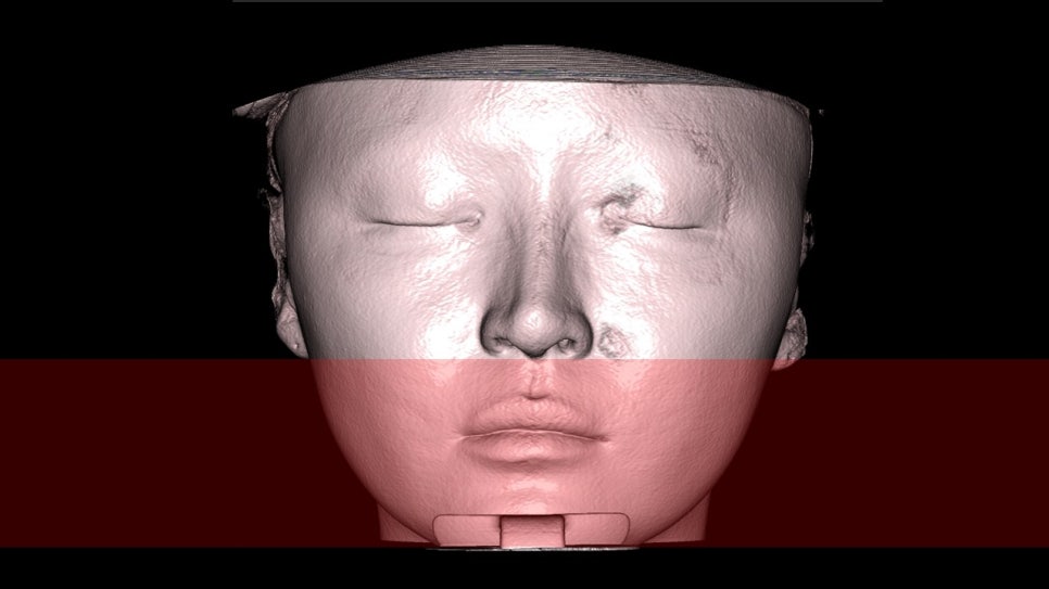 How Is Face Shape Determined? Factors That Determine Face Shape and Facial Contouring Surgery image 12
