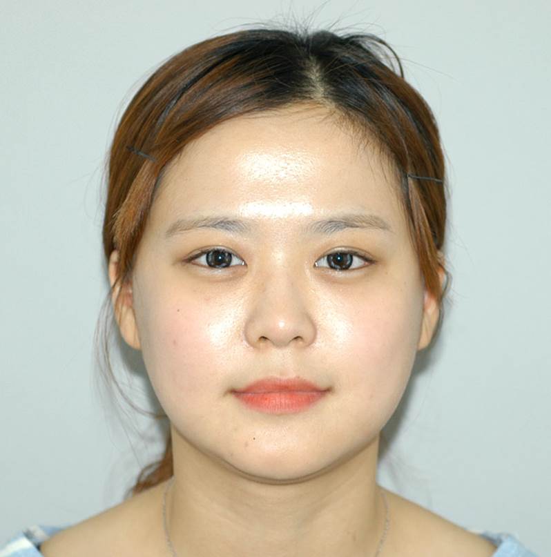 Progress After Facial Contouring Surgery 1 - Zygoma Reduction Surgery and Square Jaw Surgery image 3