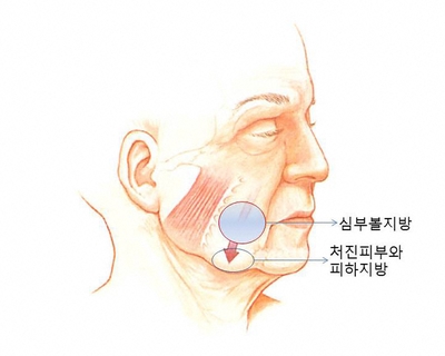 안면윤곽수술에 관한 연재 - 1. 심부볼지방제거 수술 관련 이미지 4