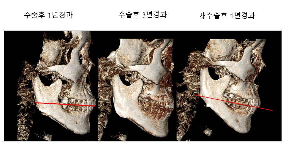 사각턱 수술후 시기에 따른 아랫턱뼈의 형태변화 관련 이미지 2