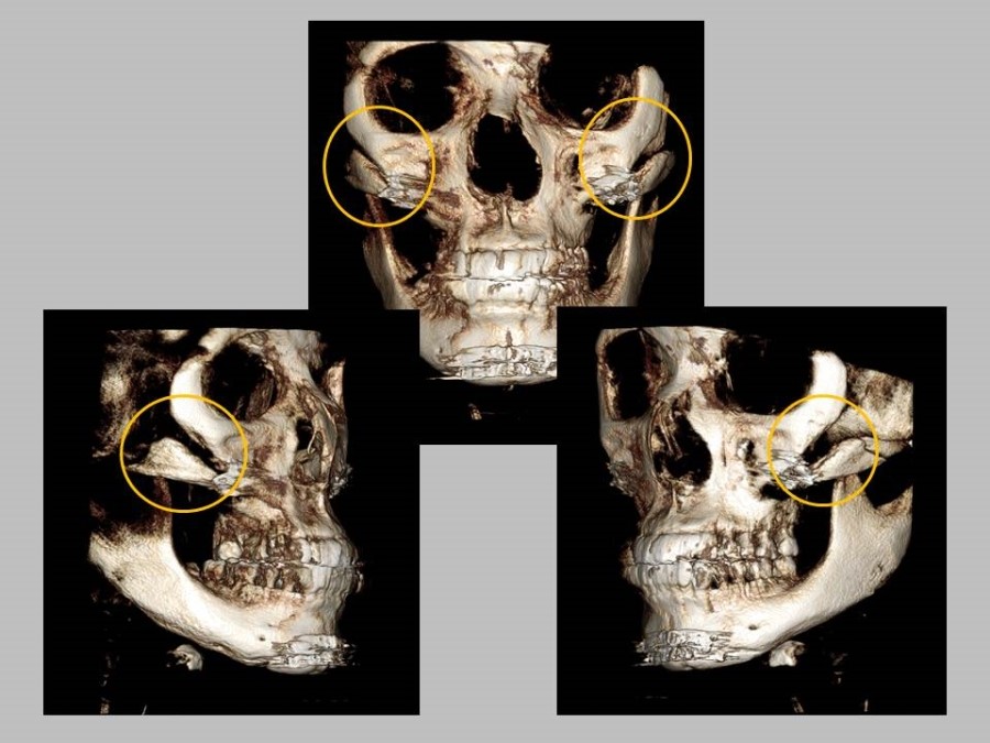 Meticulous Zygomatic Reduction Surgery image 6