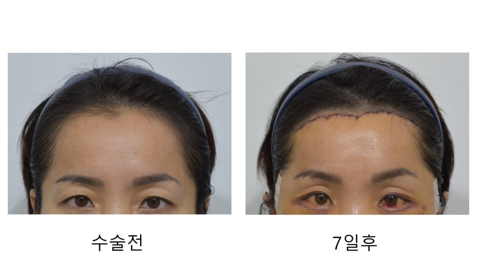 넓은 이마와 처진 눈매 고민 끝! "이마거상, 이마축소, 그리고 바이나리" 관련 이미지 14