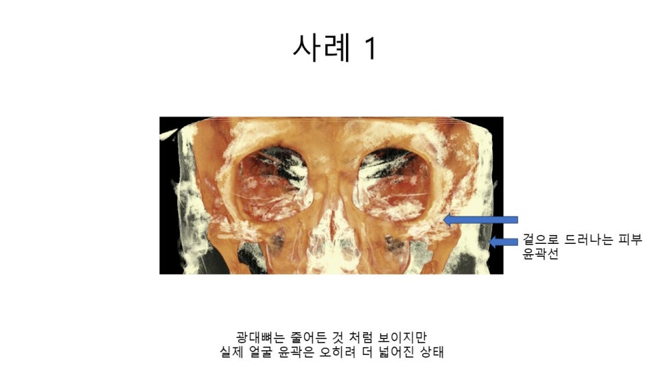 A Zygomatic Surgery Outcome That Makes Anger Surge image 10