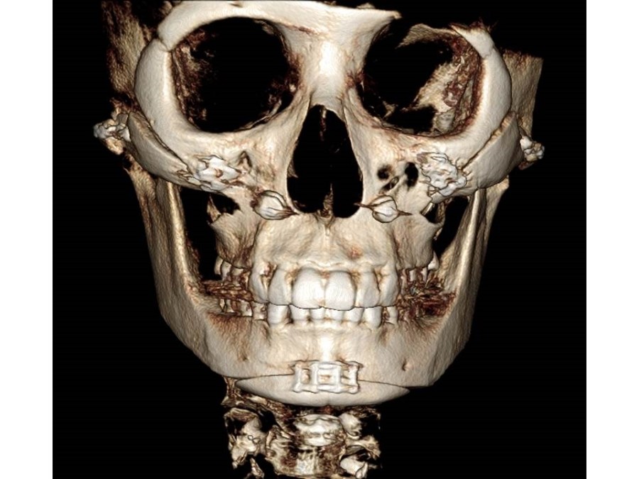 V-Line Square Jaw Surgery - The Truth and Reality of T-Osteotomy image 7